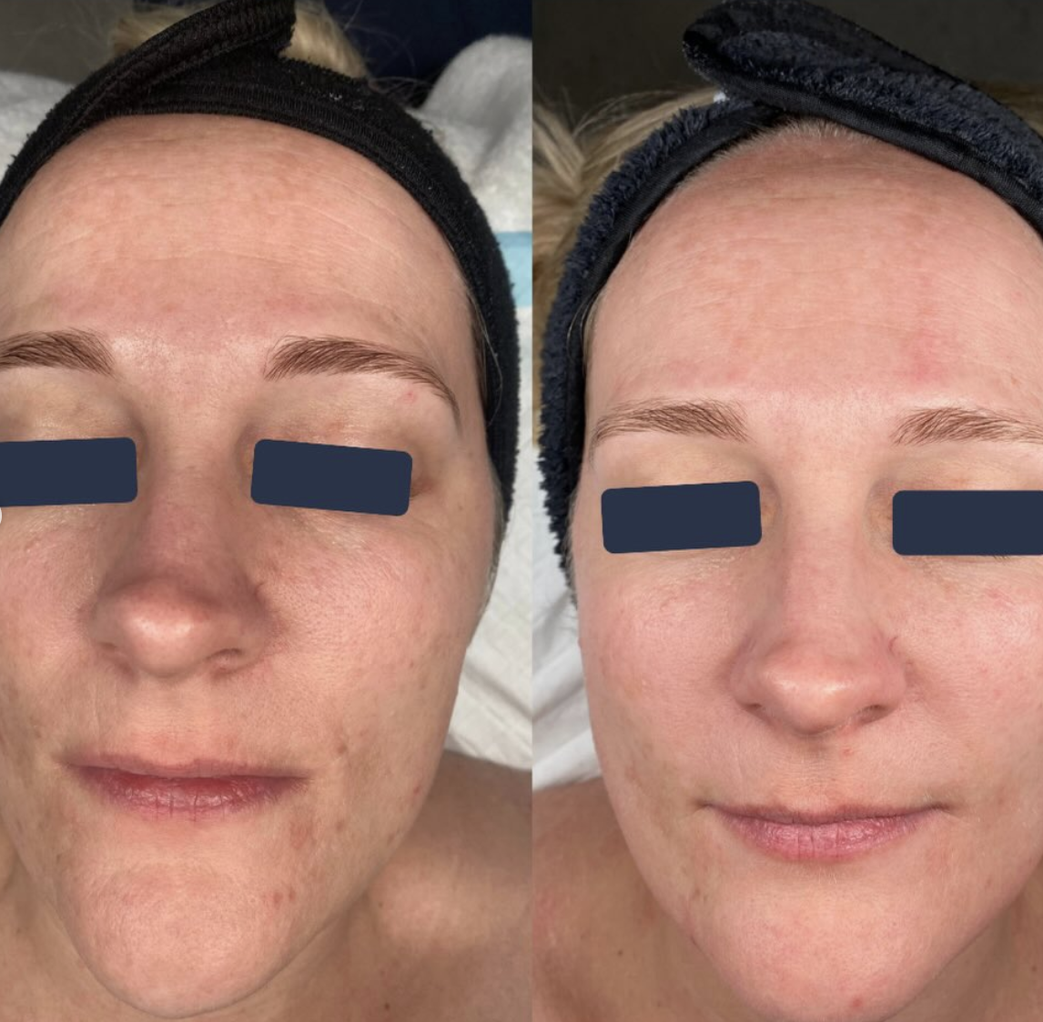 Client skin before and after treatment at Instincts Skin Clinic, result 2