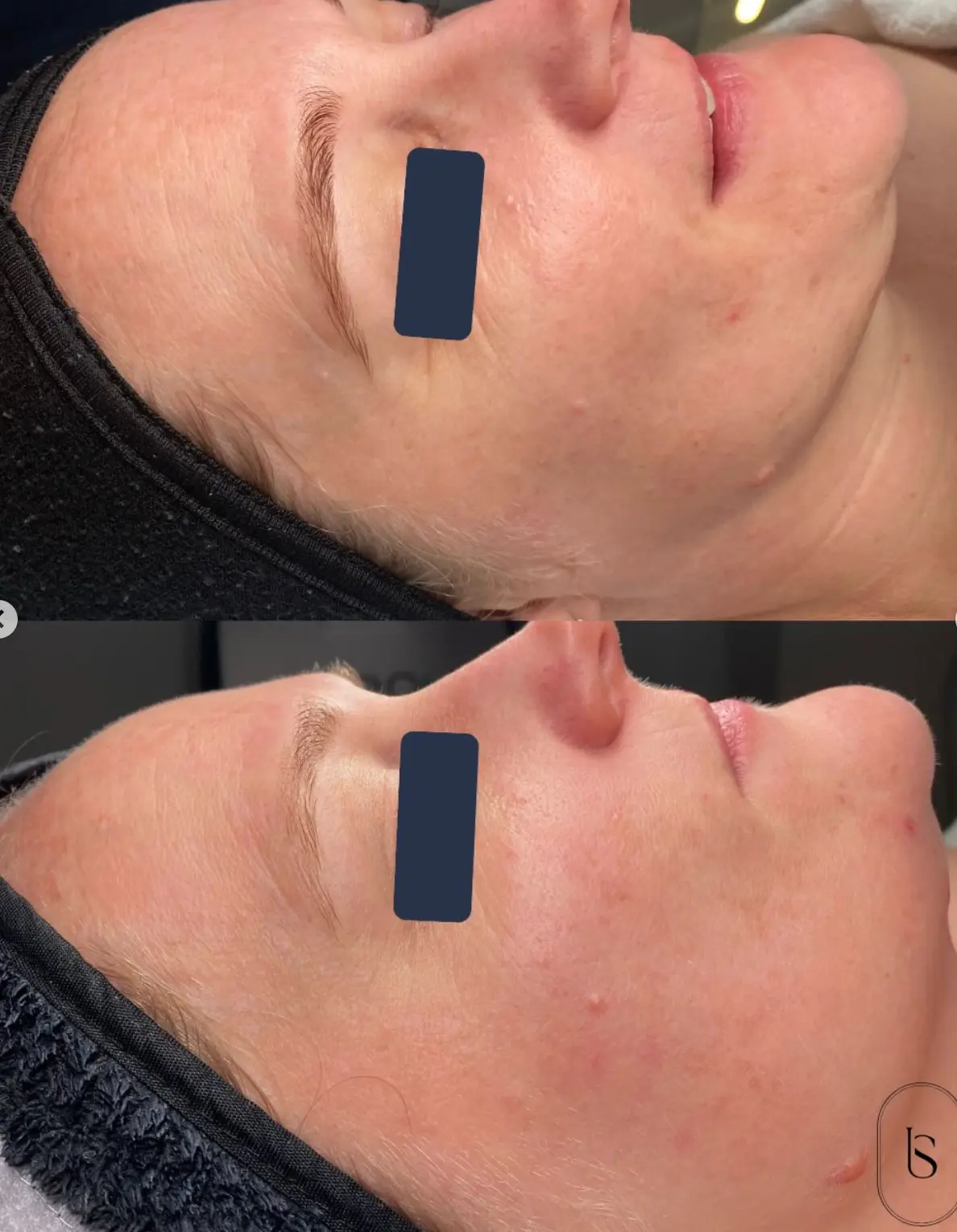 Client skin before and after treatment at Instincts Skin Clinic, result 3
