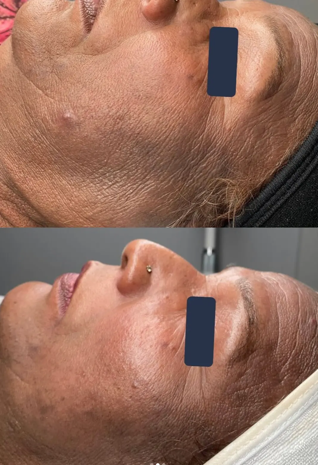 Client skin before and after treatment at Instincts Skin Clinic, result 5