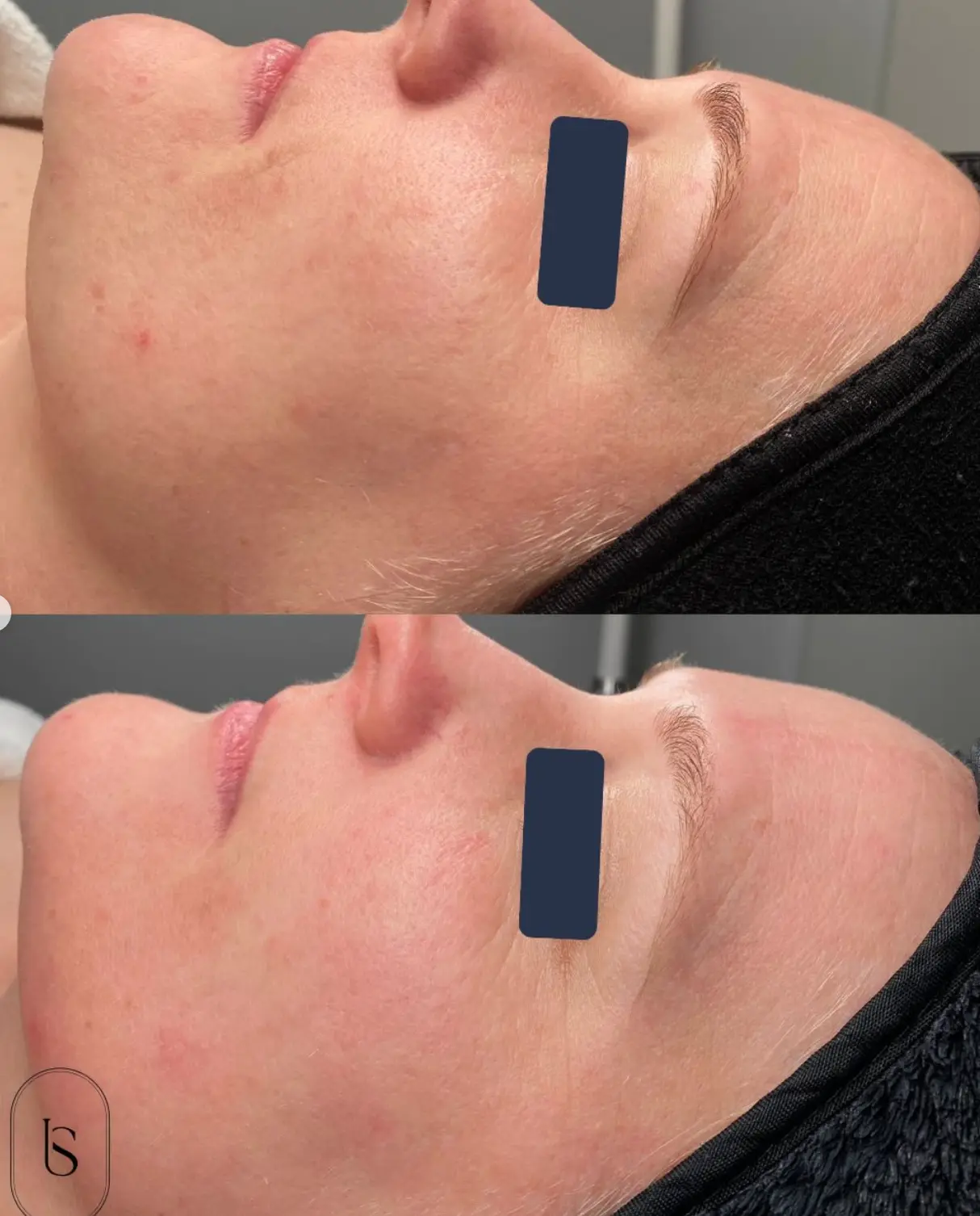 Client skin before and after treatment at Instincts Skin Clinic, result 4